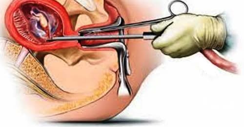 असुरक्षित गर्भपतनले लिँदै छ ज्यान