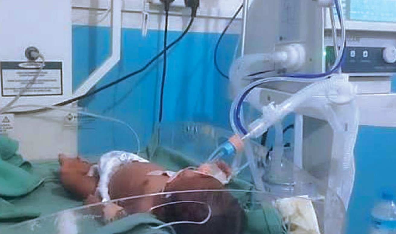 मृत्युको मुखमा पुगेका १८ दिने नवजातको समयमै उपचारपछि ज्यान बच्यो